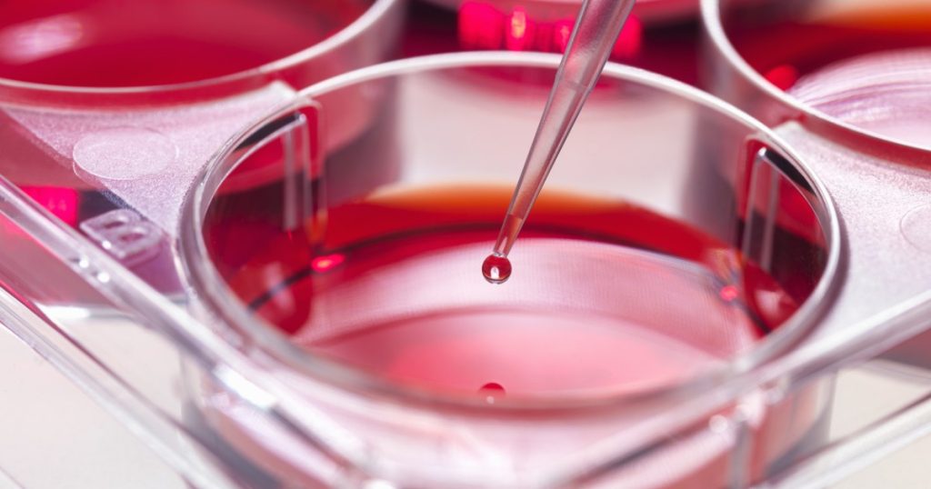 Un nou studiu promițător deschide o cale inovatoare pentru tratamentul leucemiei mieloide acute, o formă de cancer hematologic cu rate de mortalitate ridicate