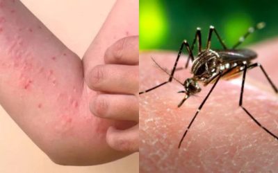 Creșterea alarmantă a cazurilor de Chikungunya în Europa adaugă o nouă dimensiune preocupărilor sanitare, transformând această boală tropicală într-o amenințare tot mai reală pentru populația continentală