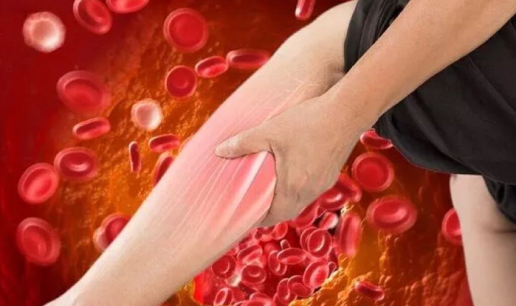 Colesterolul LDL ridicat, adesea numit și “colesterol rău”, reprezintă o amenințare tăcută pentru sănătate, fiind frecvent subestimat de către cei afectați