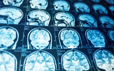 Riscul de accident vascular cerebral (AVC) poate fi influențat de grupa de sânge, o ipoteză revizuită și intens cercetată în ultimii ani, care captează tot mai mult atenția specialiștilor în neurologie și medicină preventivă