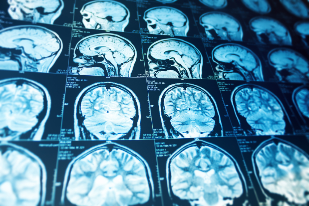 Riscul de accident vascular cerebral (AVC) poate fi influențat de grupa de sânge, o ipoteză revizuită și intens cercetată în ultimii ani, care captează tot mai mult atenția specialiștilor în neurologie și medicină preventivă