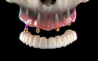 Pentru mulți oameni, zâmbetul perfect pare o poveste de domeniul fantasy-ului, un vis aproape inaccesibil din cauza pierderii unuia sau mai multor dinți sau a uzurii protezelor mobile