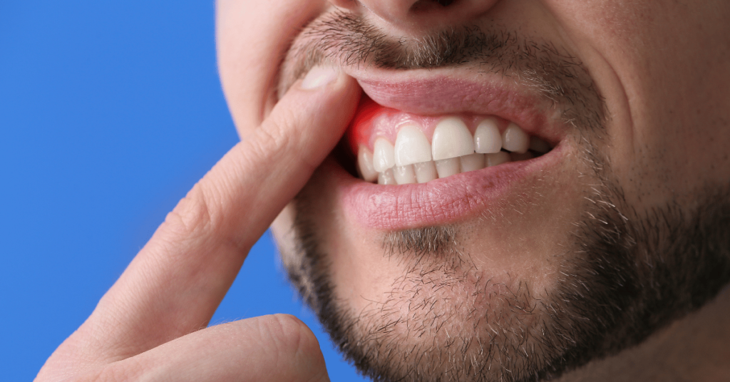 Probleme frecvente ale cavității bucale care par insa banale ar putea ascunde riscuri mai mari pentru sănătate, inclusiv pentru apariția cancerului colorectal