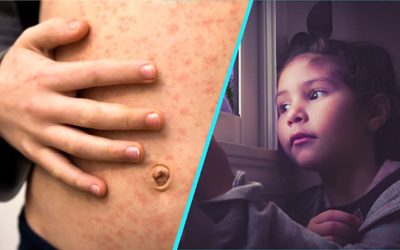 Doi pasageri cu rujeolă au aterizat pe zbor internațional; autoritățile cercetează persoanele expuse