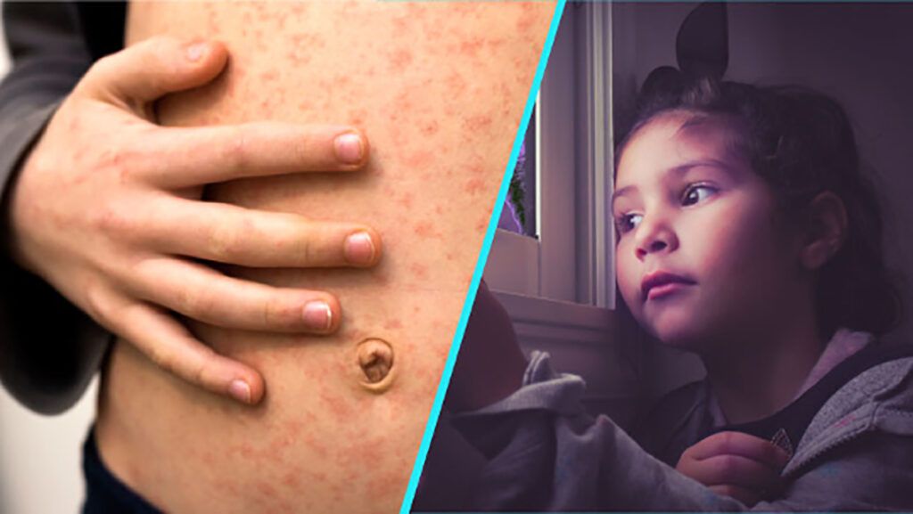 Doi pasageri cu rujeolă au aterizat pe zbor internațional; autoritățile cercetează persoanele expuse