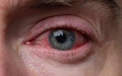 O schimbare bruscă de culoare pe albul ochiului poate produce panică, însă în cele mai multe cazuri, motivele sunt mai simple decât par