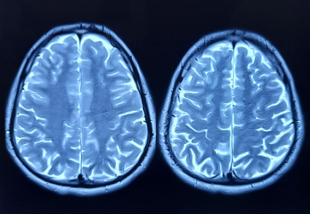 Descoperire majoră în neurologie: o proteină implicată în declinul cognitiv al bătrâneții Cercetătorii au identificat o proteină numită FTL1, care pare să joace un rol cheie în procesul de îmbătrânire a creierului