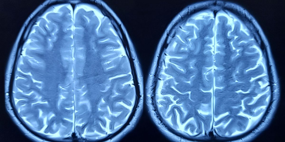 Cercetări arată ce grăbește procesul de îmbătrânire a creierului