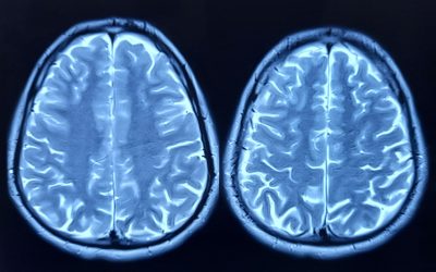 Cercetări arată ce grăbește procesul de îmbătrânire a creierului