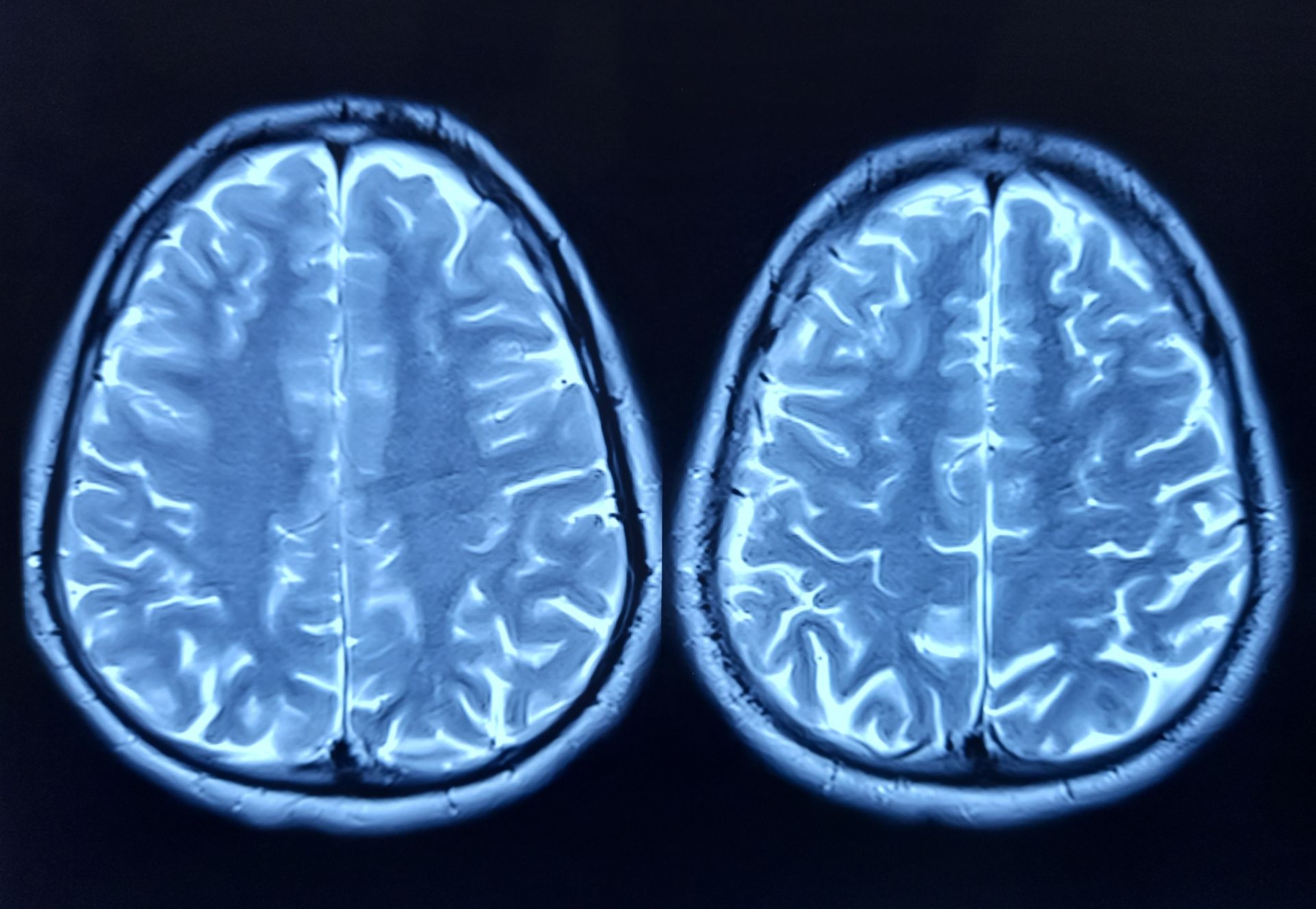 Descoperire majoră în neurologie: o proteină implicată în declinul cognitiv al bătrâneții Cercetătorii au identificat o proteină numită FTL1, care pare să joace un rol cheie în procesul de îmbătrânire a creierului