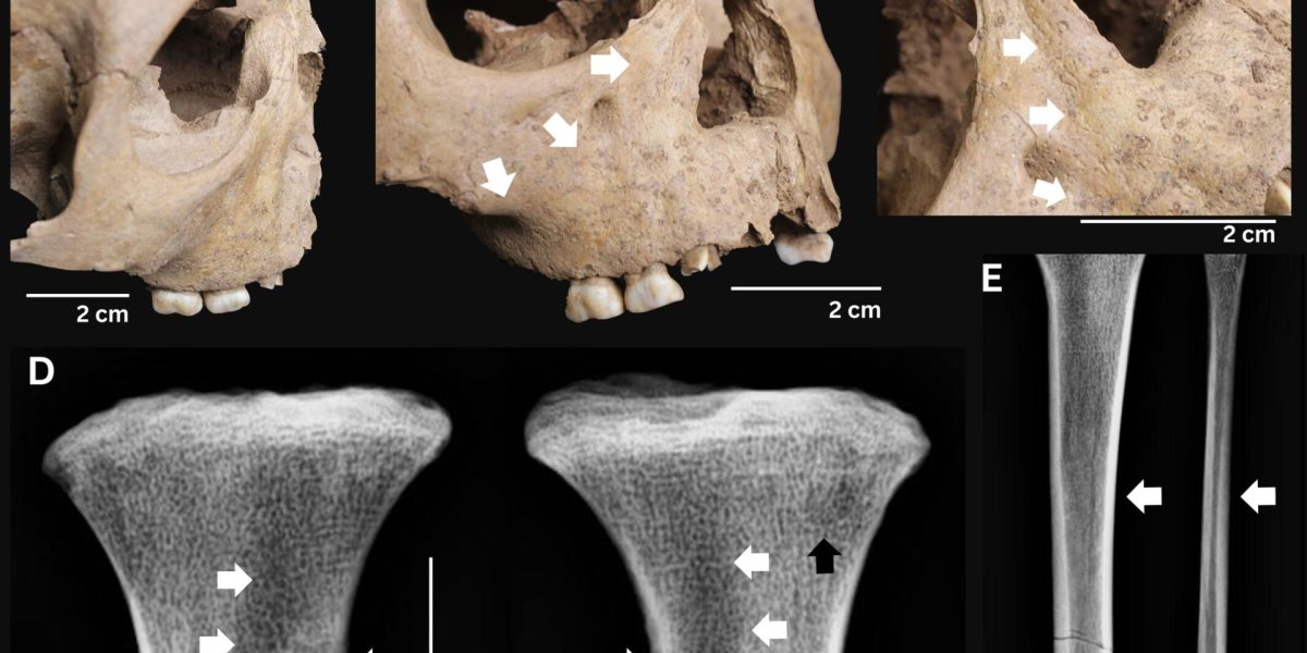 Dinții nemți ai copiilor antis, semnele unui diagnostic grav de acum 4000 de ani