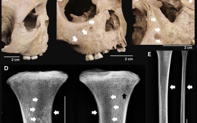 Dinții nemți ai copiilor antis, semnele unui diagnostic grav de acum 4000 de ani