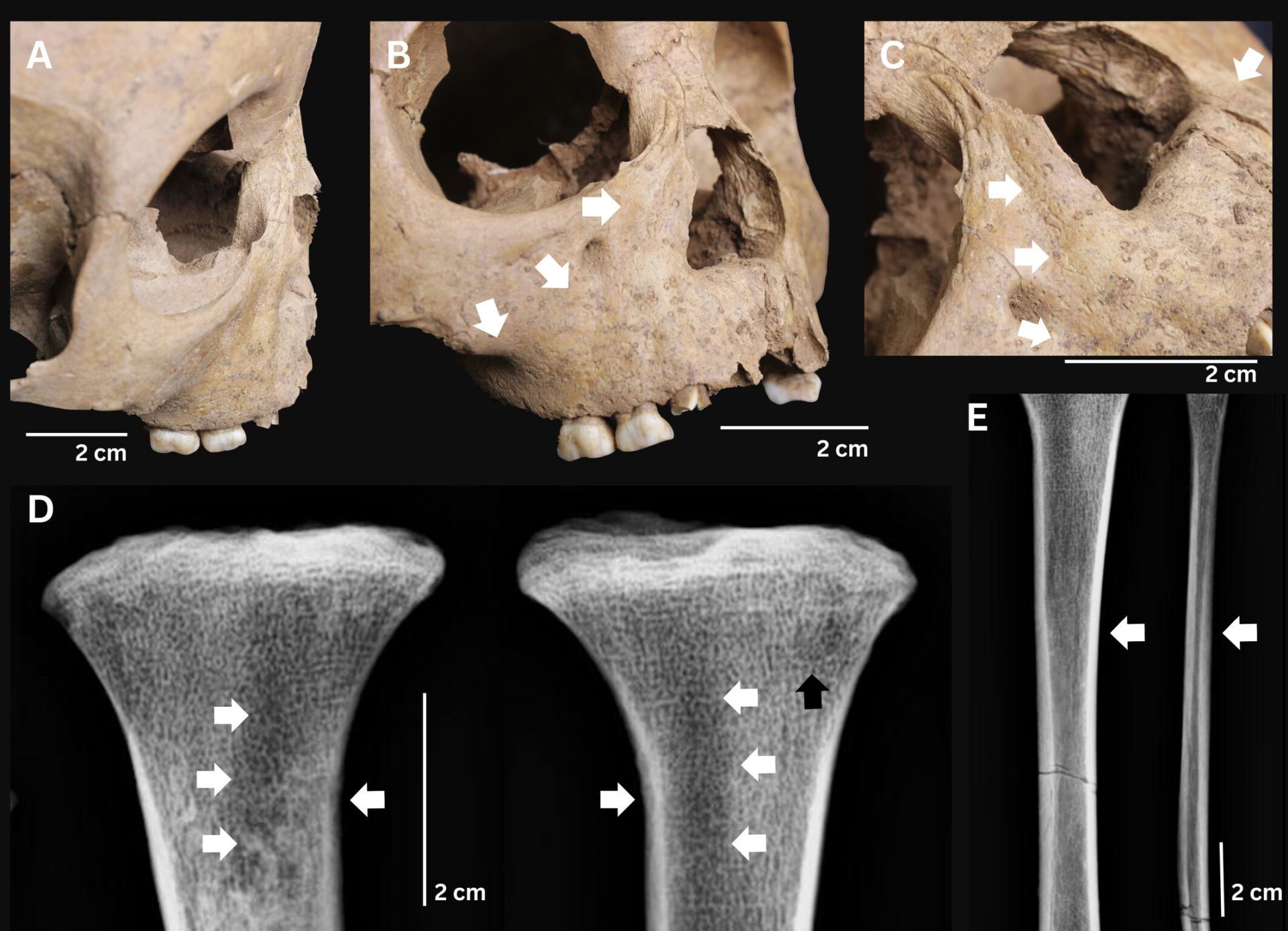 Arheologii din Vietnam au descoperit urme ale unei boli bacteriene grave, în scheletele a trei copii antici, fapt ce poate schimba fața înțelegerii despre originea sifilisului