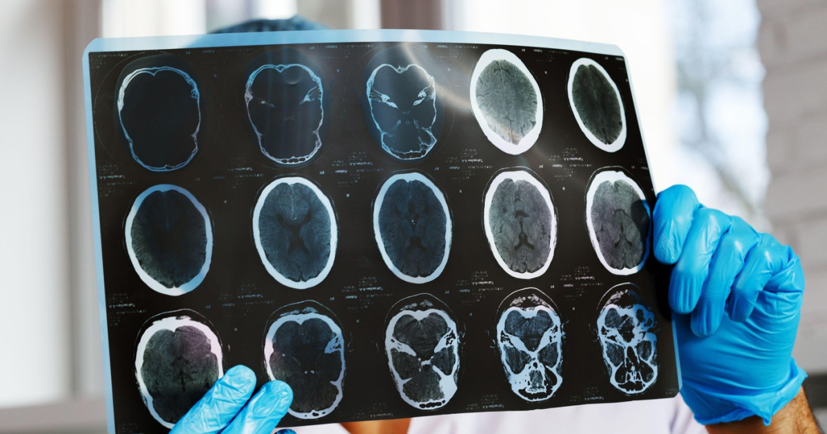 Organizațiile de pacienți cer intervenția urgentă a autorităților în urma scăderii semnificative a monitorizării pacienților cronici Numărul investigațiilor de monitorizare de înaltă performanță pentru pacienții cronici a înregistrat o reducere de aproximativ 47% într-o singură lună, după aplicarea noilor reguli de decontare de la începutul anului