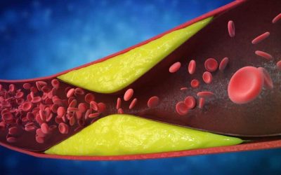 Șapte semne de ALARMĂ ale arterelor blocate: Ce NU trebuie să ignoare românii