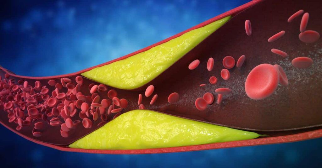 Șapte semne de ALARMĂ ale arterelor blocate: Ce NU trebuie să ignoare românii