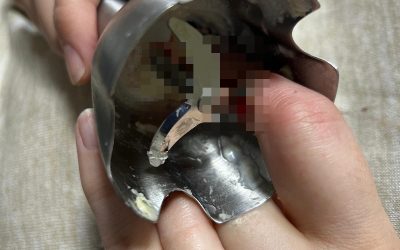 Două femei din Iași, victime ale unor accidente casnice grave