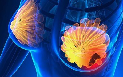 Semnele cancerului de sân: 5 simptome la care să fii atentă