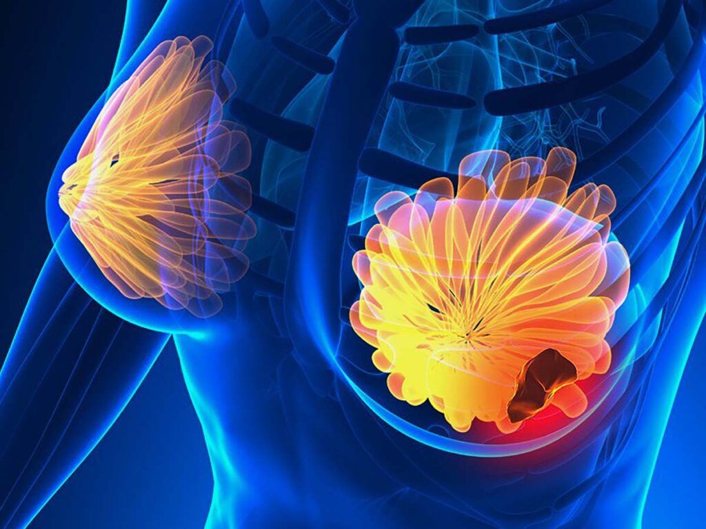Semnele cancerului de sân: 5 simptome la care să fii atentă