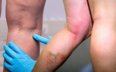 Vitamina-minune: Protejează de cheaguri și întărește imunitatea