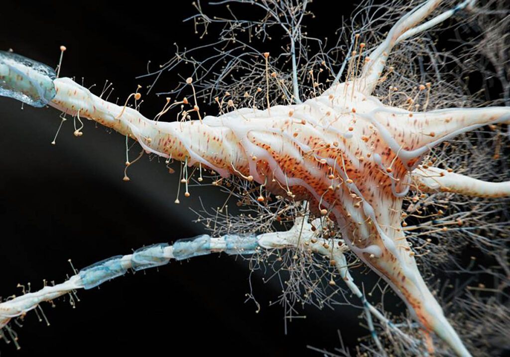 Inflamația intestinală, nou factor în scleroza multiplă