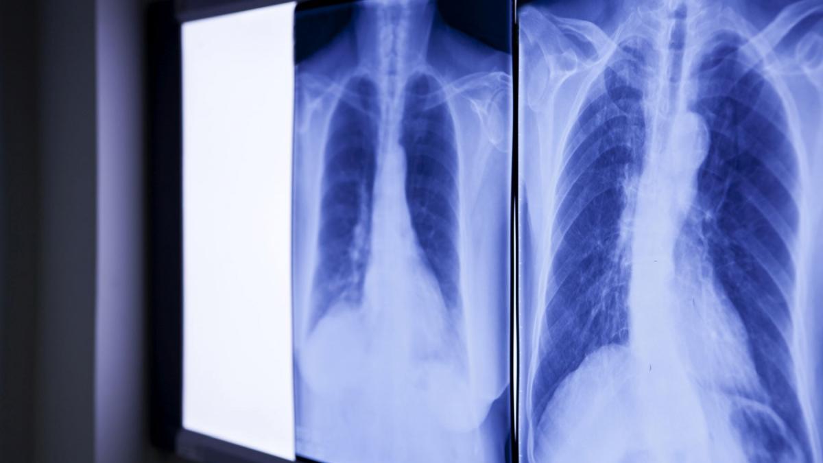 Medici, șocați: Ce au găsit în abdomenul unui bărbat. E acolo de peste 20 de ani