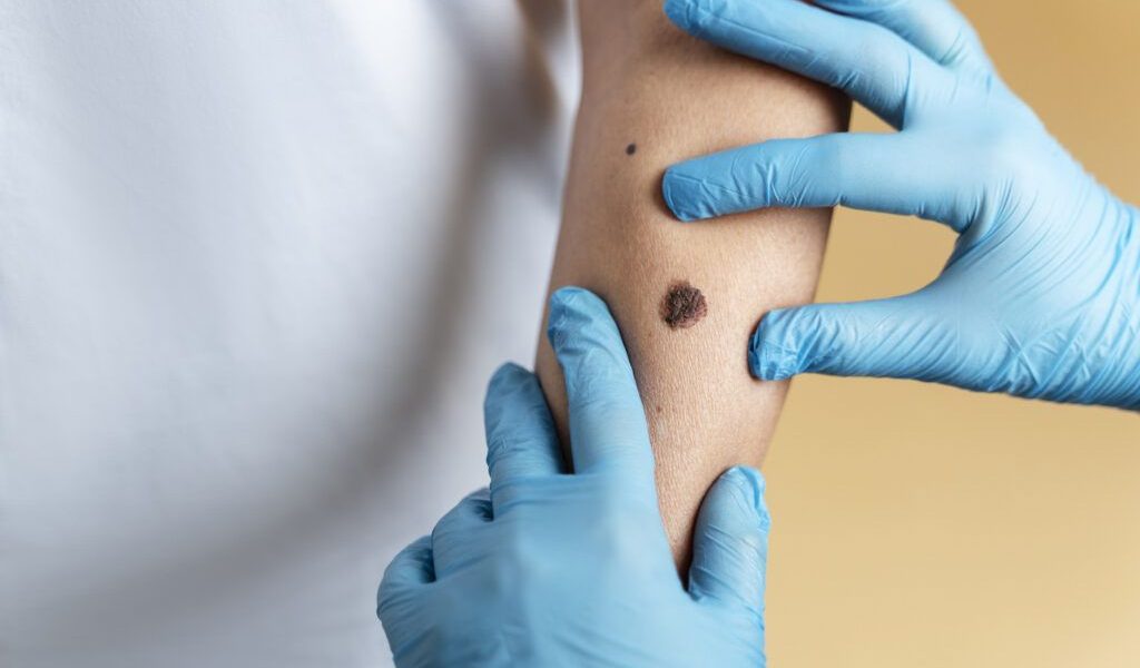 Moarte ȘOC în România: O femeie a murit după ce și-a scos o aluniță