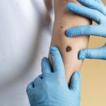 Moarte ȘOC în România: O femeie a murit după ce și-a scos o aluniță