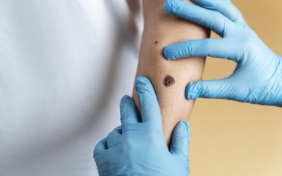 O tânără mamă din Anglia a pierdut lupta cu viața din cauza unei afecțiuni grave, ignorată inițial, readucând în prim-plan importanța crucială a depistării la timp a cancerului de piele