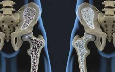 Oase mai puternice: Nou tratament vindecă osteoporoza și reface densitatea