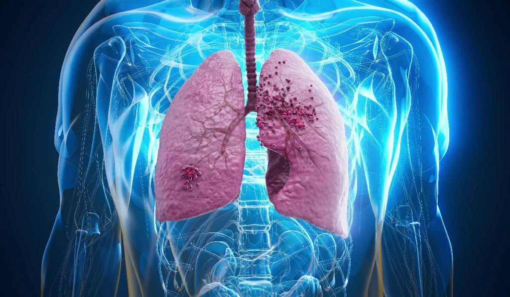 Cancerul pulmonar, o boală cu impact major la nivel mondial, se menține ca una dintre cele mai răspândite și letale forme de cancer