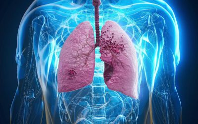 Cancerul pulmonar, o boală cu impact major la nivel mondial, se menține ca una dintre cele mai răspândite și letale forme de cancer