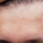 Acid salicilic: protocol anti-acnee în 3 pași. Ghid complet (P)