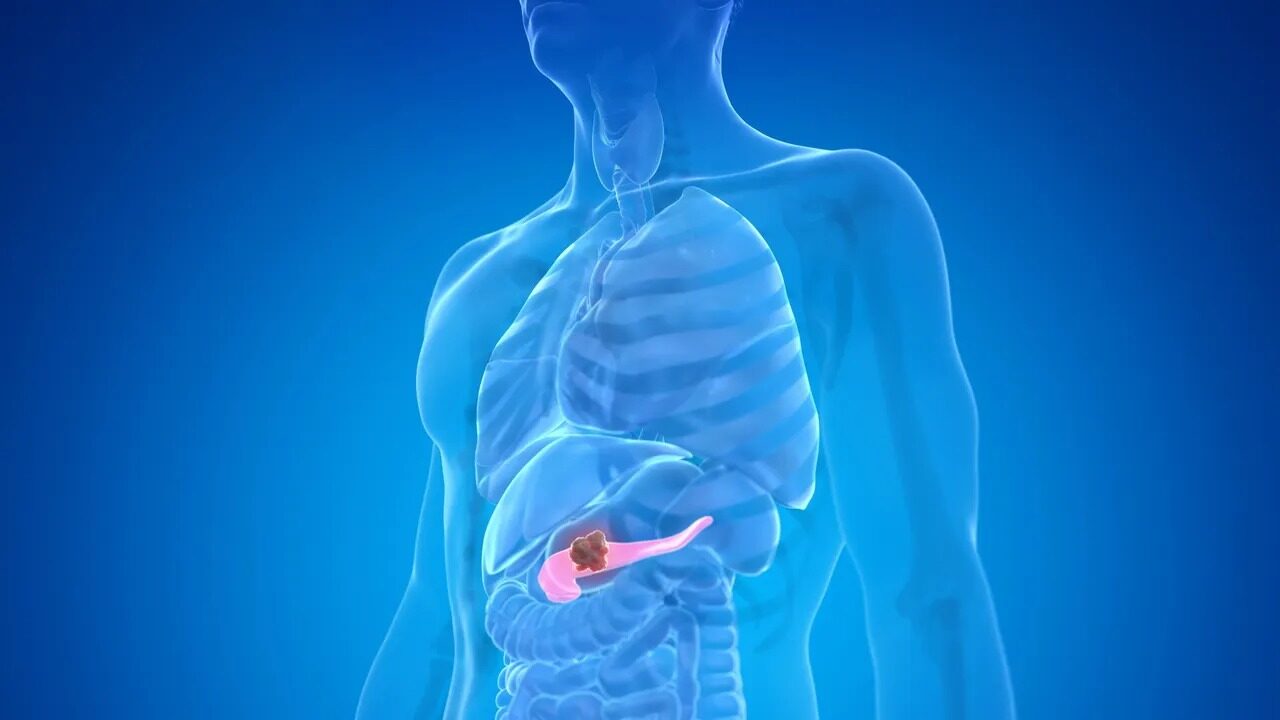 Model revoluționar în oncologie: O nouă speranță pentru pacienți