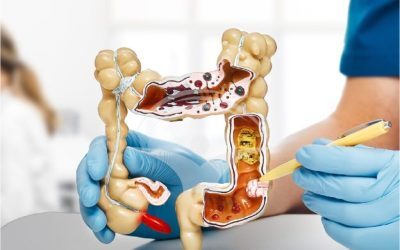 Cancer colon: Medicul explică SEMNUL DE ALARMĂ crucial