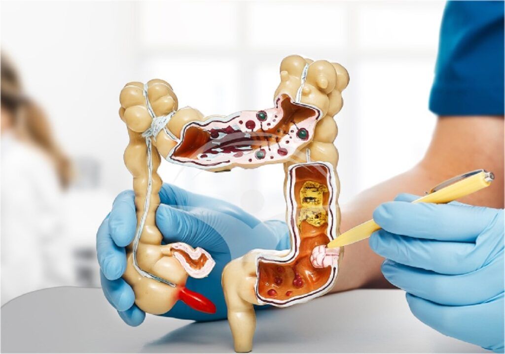 Cancer colon: Medicul explică SEMNUL DE ALARMĂ crucial