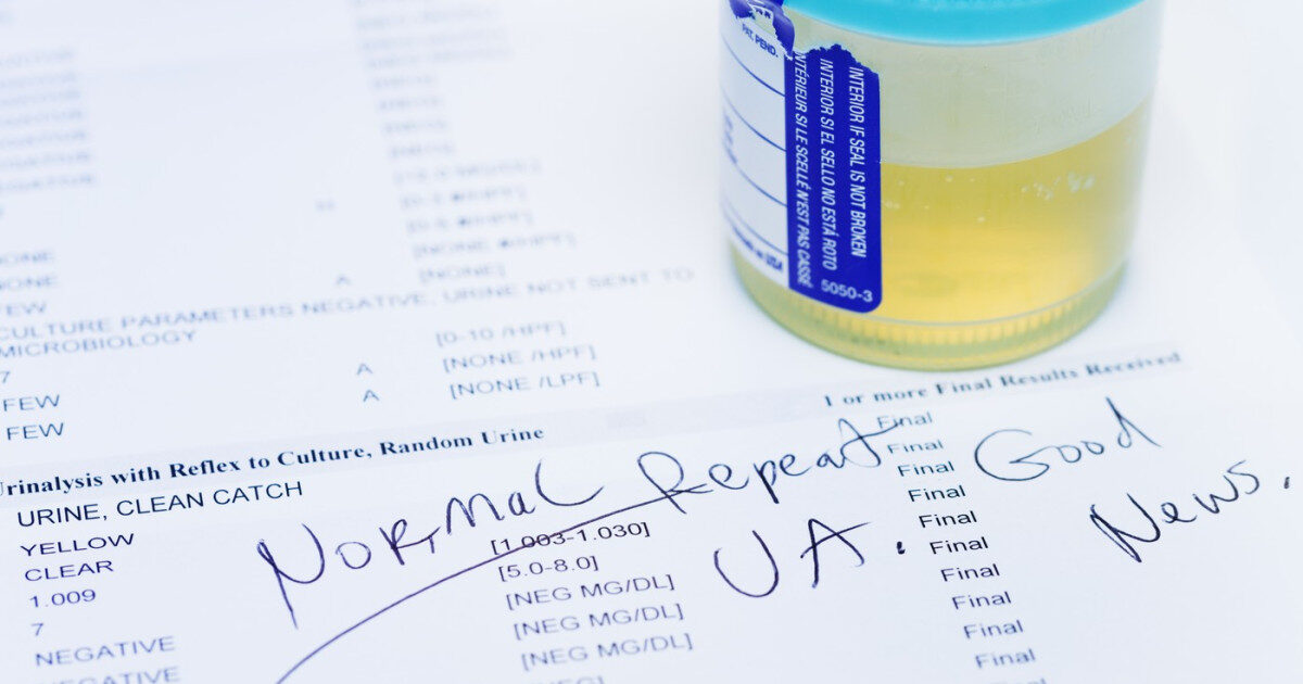 Test de urină: Detectează 9 din 10 cazuri de cancer de vezică